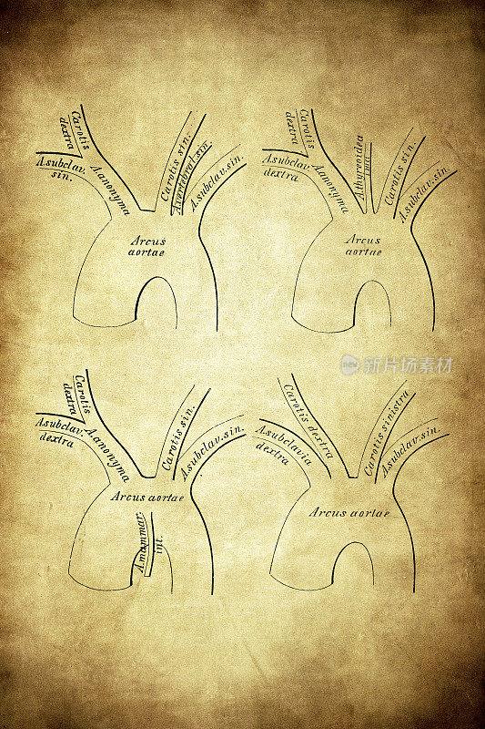 Scheme of the varieties of arteries arising from the aortic arch through multiplication
